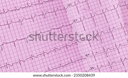 Rhythm beat pulse rate red grid paper that shows sinus rhythm abnormality of right ventricular hypertrophy. Cardiac fibrillation. Vital sign. Medical healthcare symbol.