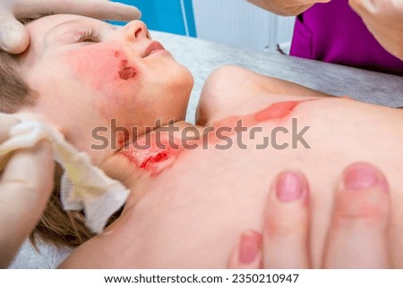medical procedure dressing a boy with a first-degree burn from boiling water on his face, neck and chest Royalty-Free Stock Photo #2350210947