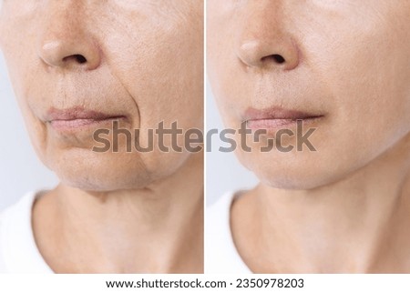 Lower part of elderly woman's face and neck with signs of skin aging before after facelift, plastic surgery. Age-related changes, flabby sagging skin, wrinkles, creases. Rejuvenating procedures Royalty-Free Stock Photo #2350978203