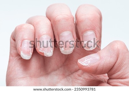 Flaky bitten and brittle nails without a manicure. Regrown nail cuticle and damaged nail plate after gel polish. Royalty-Free Stock Photo #2350993781