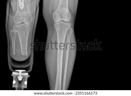 
Images of the legs while wearing prostheses and x-rays of the legs to see abnormalities of the leg bones. normal tone black background Royalty-Free Stock Photo #2351166173