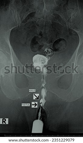 Special examination Fistulography a male 80 year old. x-ray image of fistulography examination. posteroanterior position. PA view of roentgen image fistulography.