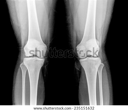X-ray of both human knee.