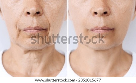 Lower part of face and neck of a caucasian elderly woman with signs of skin aging before after facelift, plastic surgery. Age-related changes, flabby saggy skin, wrinkles, creases. Rejuvenation