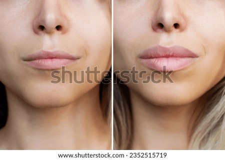 Result of lip augmentation. Cropped shot of young blonde woman's lower part of face with lips before and after lip enhancement. Injection of filler in lips. Difference, comparison Royalty-Free Stock Photo #2352515719