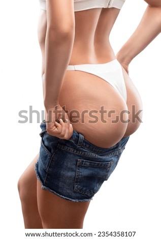 A beautiful slender woman in blue denim shorts lost a lot of weight. She shows stretch marks on the skin of her thighs. The concept of weight loss, healthy intestines and lifestyle.