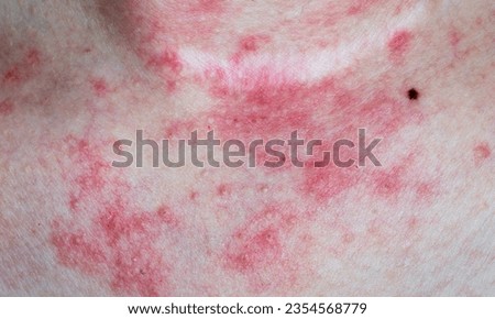 Eczema (Atopic Dermatitis):
Eczema is a chronic inflammatory condition characterized by red, itchy, and inflamed skin. It often appears as patches on the skin that can be dry, scaly, and may even ooze Royalty-Free Stock Photo #2354568779
