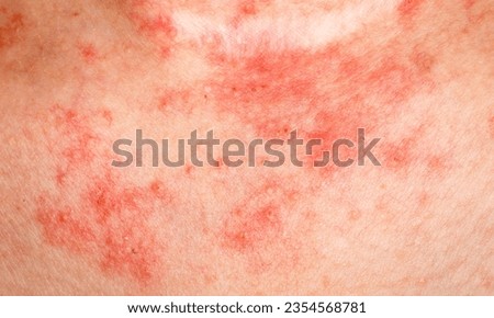 Eczema (Atopic Dermatitis):
Eczema is a chronic inflammatory condition characterized by red, itchy, and inflamed skin. It often appears as patches on the skin that can be dry, scaly, and may even ooze Royalty-Free Stock Photo #2354568781