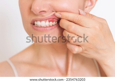 a close-up photo of a young Caucasian woman who shows off her red gums on the upper jaw, suffers from gum inflammation. Dental care. Dentistry Royalty-Free Stock Photo #2354763203