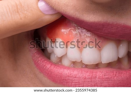 Close-up Of A Woman's Finger Showing Swelling Of Her Gum Royalty-Free Stock Photo #2355974385