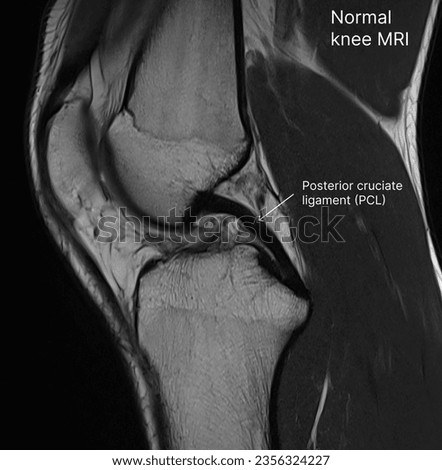 Normal knee MRI with posterior cruciate ligament (PCL) labelled Royalty-Free Stock Photo #2356324227