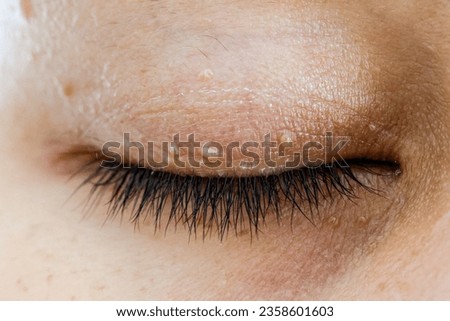 Close up upper eyelid skin tag, Macro photography.