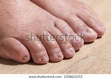 Cancer chemotherapy cause swelling of ankles (ankle oedema) , 
 skin to become dry, dark or peel and nails brittle or flaky. Royalty-Free Stock Photo #2358622553