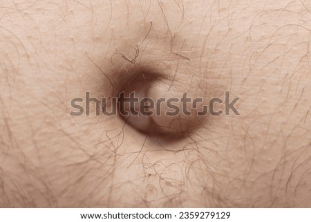 An umbilical hernia appears as a painless lump in or near the belly button (navel) Royalty-Free Stock Photo #2359279129