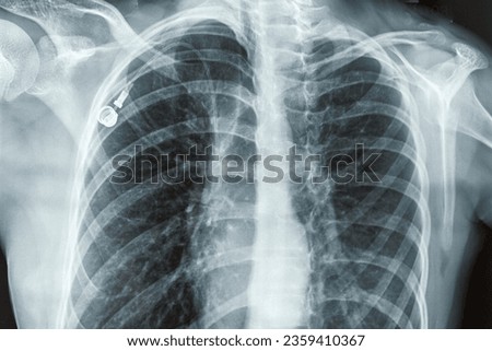 X-ray of a person s lungs and breast with Port Catheter. Virus, cancer or infusion port Insertion screening