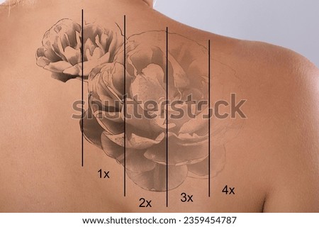 Laser Tattoo Removal On Woman's Shoulder Against Gray Background Royalty-Free Stock Photo #2359454787