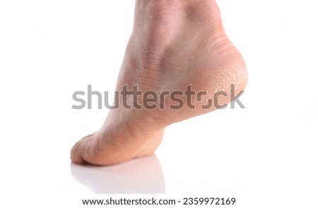 The heel of foot with bad skin is covered with cracks. The concept using medical treatment with moisturizers and also vedekure and peeling of wound healing and pain while walking swatch dermatologist Royalty-Free Stock Photo #2359972169