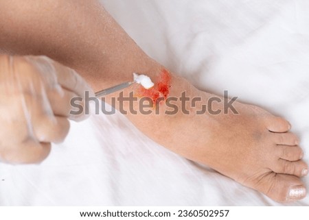 doctor treats healing wound from severe burn on leg adult female patient, redness, scarring of skin, medical care, human tissue regeneration Royalty-Free Stock Photo #2360502957