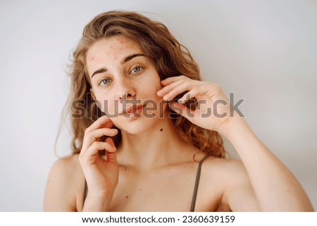 Close-up portrait of a beautiful woman without makeup with imperfect skin. Acne skin. Natural beauty. Medicine and cosmetology. Royalty-Free Stock Photo #2360639159