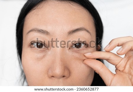 Asian Woman With Under Eye Bag. Puffy Eye Of Girl Showing Eyes Bags.