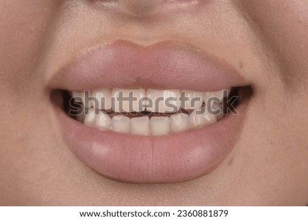Transform Your Smile with Dental Veneers: Enhance Your Appearance with Customized Porcelain Facets	
