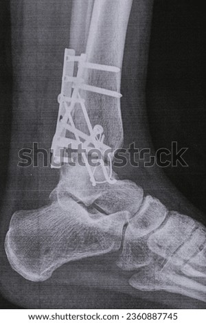X-ray, a picture of the leg bones after surgery in the hands of a doctor