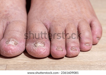 Cancer chemotherapy cause swelling of ankles (ankle oedema) , 
 skin to become dry, dark or peel and nails brittle or flaky. Royalty-Free Stock Photo #2361609081