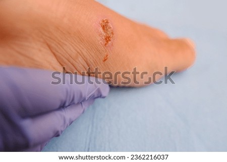 doctor treats weeping wound, trophic ulcer on female leg, wound exudate prevents healing ulcers by destroying growth factors, concept eliminating inflammatory process, sanitation pathogenic microflora Royalty-Free Stock Photo #2362216037