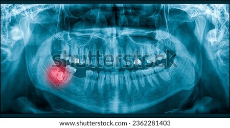 Growing Wisdom Toothache On X-Ray Royalty-Free Stock Photo #2362281403