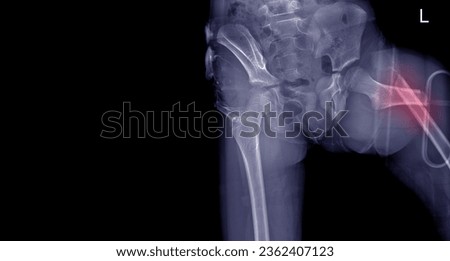 X-ray image of the patient's hip showing a broken thigh with a black background. Royalty-Free Stock Photo #2362407123