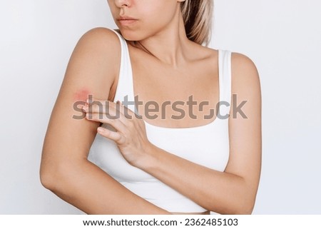 Worried young woman touching an insect bite on her arm isolated on white background. A red rash caused by allergy, inflammatory process. Eczema, atopic dermatitis, lichen, allergy, itching, psoriasis Royalty-Free Stock Photo #2362485103