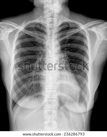 chest x-ray of women