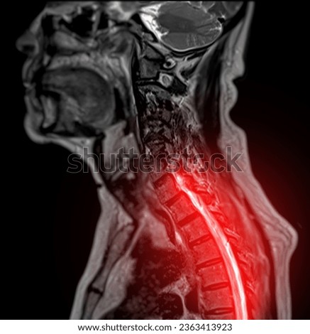MRI of  C-spine or magnetic resonance image of cervical spine sagittal T2 FS view  for diagnosis spondylosis causing cervical spondylotic myelopathy and compression fracture. Royalty-Free Stock Photo #2363413923