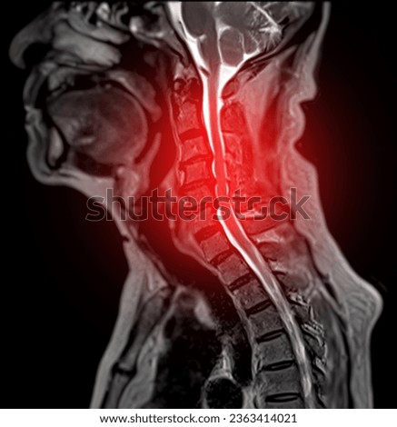 MRI of  C-spine or magnetic resonance image of cervical spine sagittal T2 FS view  for diagnosis spondylosis causing cervical spondylotic myelopathy and compression fracture. Royalty-Free Stock Photo #2363414021