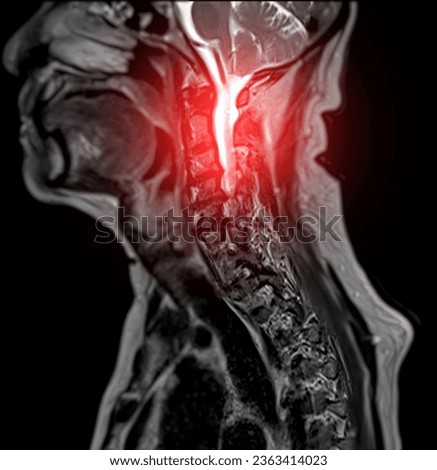 MRI of  C-spine or magnetic resonance image of cervical spine sagittal T2 FS view  for diagnosis spondylosis causing cervical spondylotic myelopathy and compression fracture. Royalty-Free Stock Photo #2363414023