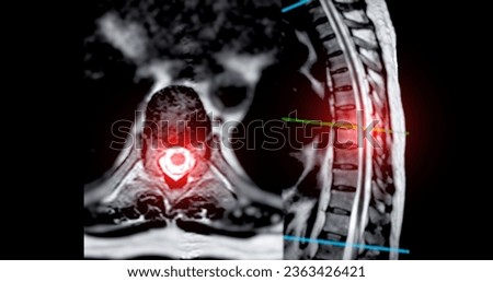 MRI T-L spine or Thoracosacral spine Axial and sagittal T2 technique with reference line  for diagnosis spinal cord compression. Royalty-Free Stock Photo #2363426421