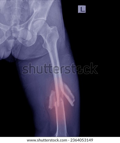 
X-ray image The patient's thigh shows cracks and deformities on a black background.