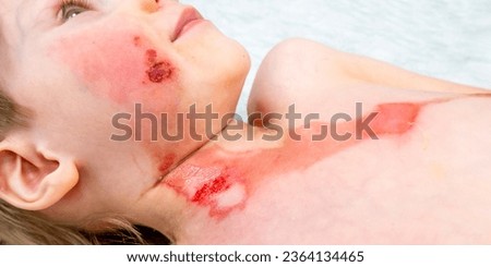medical procedure dressing a boy with a first-degree burn from boiling water on his face, neck and chest Royalty-Free Stock Photo #2364134465
