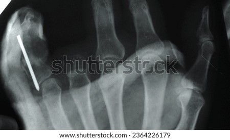 Doctor Radiologist Examining X-Ray Image of Hands Wrists POV