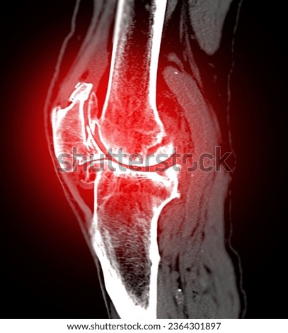 CT Knee or CT Scan image of knee joint sagittal view .