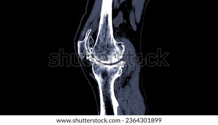 CT Knee or CT Scan image of knee joint sagittal view .
