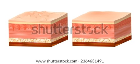 Dry and healthy skin texture. Infographic with Human skin layers diagram. Before and after skin moisturization.  Royalty-Free Stock Photo #2364631491