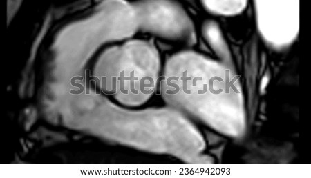 MRI heart or Cardiac MRI ( magnetic resonance imaging ) of heart showing aortic valve . Royalty-Free Stock Photo #2364942093
