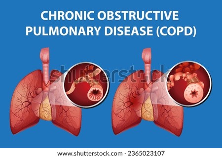 Illustrated cartoon-style image depicting the science education of human anatomy and chronic obstructive pulmonary disease Royalty-Free Stock Photo #2365023107