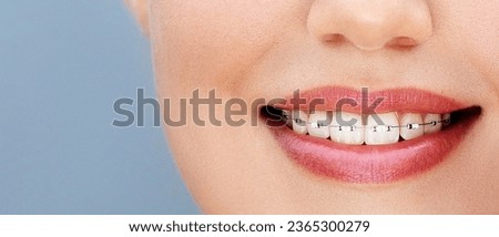 Braces close up. Female mouth smile with a dental oral care treatment. Orthodontistry Royalty-Free Stock Photo #2365300279