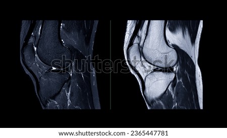 Magnetic resonance imaging of knee joint or MRI knee sagittal for detect tear or sprain of the anterior cruciate ligament (ACL).	

 Royalty-Free Stock Photo #2365447781