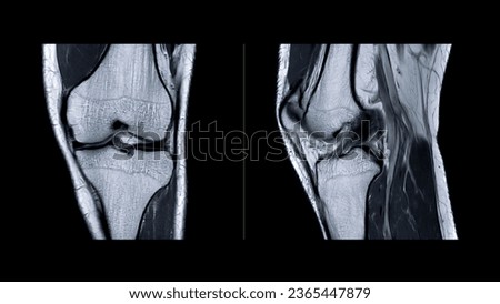 Magnetic resonance imaging of knee joint or MRI knee sagittal for detect tear or sprain of the anterior cruciate ligament (ACL).	

 Royalty-Free Stock Photo #2365447879