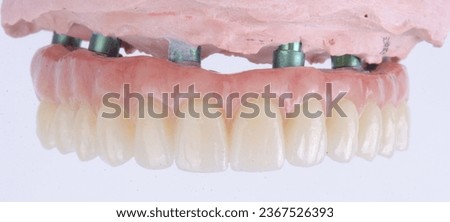 Prosthesis of All-on-4 or All-on-6, which’s ceramic teeth on metal bar. The kind of fixed detachable prosthesis on dental implants. Royalty-Free Stock Photo #2367526393