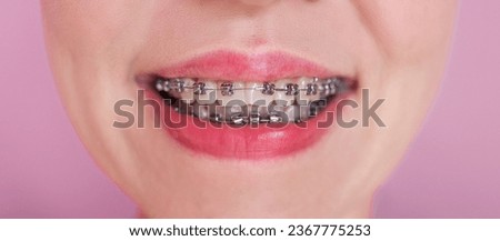 Close-up of a young woman smiling with braces on her teeth. Braces system in smiling mouth, macro photo teeth, close-up lips, macro shot.