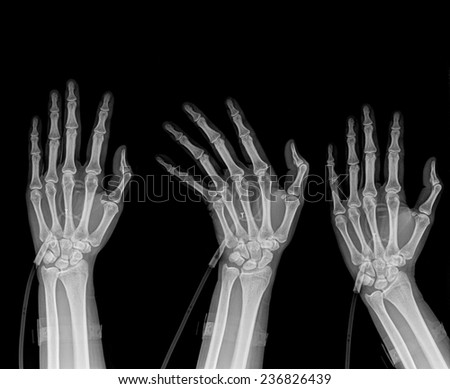 three  hands position on x-ray isolated on black background